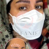 کاشت ابرو میکرو کاشت بلفارو پلاستی ۱۰میلیون تومان