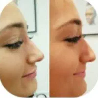 رفع نواقص بینی