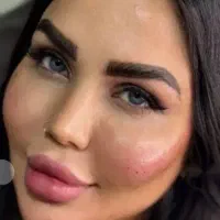 ژل و فیلر