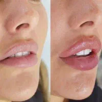 ژل و فیلر و آنزیم و بوتاکس توسط پزشک