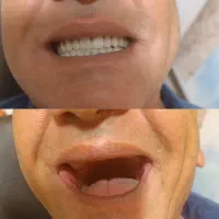 دندانسازی پیرهادی بامتد جدید کنترل لقی دندان