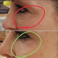 کرم  جایگزین بوتاکس