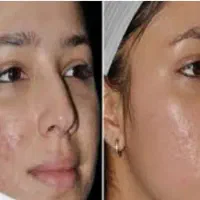 حذف دائمی خال ، مزونیدلینگ صورت وبدن
