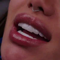 کامپوزیت دندان با تخفیف ویژه تابستان