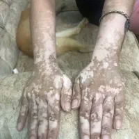 خودایمنی/روماتیسم/پیسی/پسوریازیس/مشاوره تخصصی رایگ