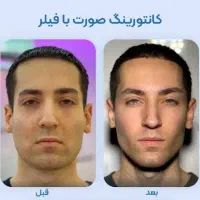بوتاکس خطوط فیلرلب .عکس چهره بده برات آنالیز کنم