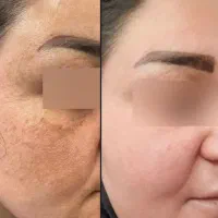 کرم ضدلک فوری‌ تضمینی