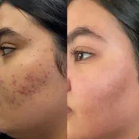 ضد جوش|آرایشی، بهداشتی، درمانی|زاهدان, |دیوار