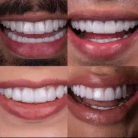 کامپوزیت دندان روکش سرامیکی ایمپلنت لمینت