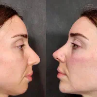 تغییر شکل بینی بدون عمل جراحی