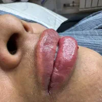 تزریق و آموزش هیپ دیپ ژل و بوتاکس