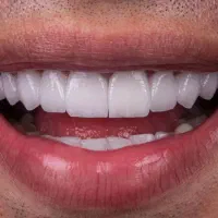 دندانپزشکی کامپوزیت روکش عصب کشی