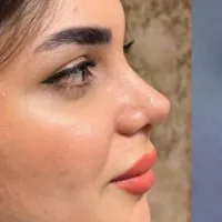 عمل بینی/سانترال لب/بلفارو پلاستی|خدمات آرایشگری و زیبایی|مشهد, احمدآباد|دیوار