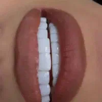 کامپوزیت لمینت درمانی اقساطی دندان تخفیف ویژه