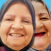 دندان مصنوعی طرح لمینیت
