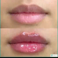 فیلر۷۰۰، ژل و بوتاکس، پرسینگ، بن مژه، و مژه