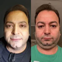 لیفت صورت