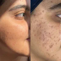 پاکسازی و فیشیال تخصصی پوست