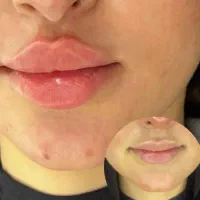 ژل و بوتاکس و مزو و چال گونه