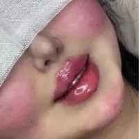 تزریق ژل و بوتاکس و شاین بادی