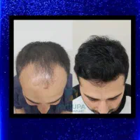 نه به کلاه گیس