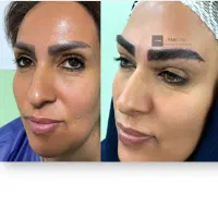کاشت ابرو رایگان