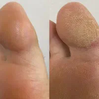 آفر ویژه خدمات پدیکور کلینیکال در بوشهر