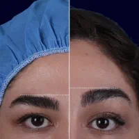 لیفت شقیقه بدون بیهوشی و درد