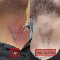 جشنواره لیزر ملورین/لیزر روشنسازی/موهای زائد