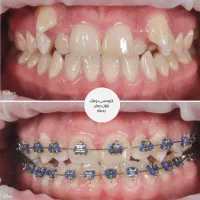 ارتودنسی با پرداخت اقساطی .. کمترین قیمت شیراز