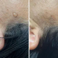 درمان بیماریhpv