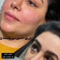 جشنواره تخفیف پی آر پی،پلاسما ژل،بایوفیلر