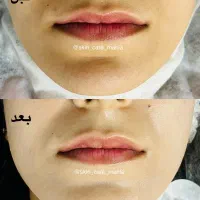 فیشال و پاکسازی پوست