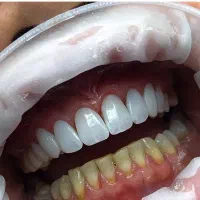 لمینیت عصب کشی روکش پر کردن کامپوزیت ایمپلنت