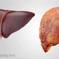 کبدچرب مرگ خاموش
