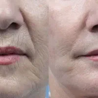 بمب جوانسازی با بیوممتیک