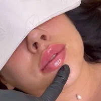 جشنواره تخفیف بوتاکس‌/ژل‌/فیلر/تزریق پزشک‌ وآموزش