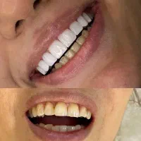 جشنواره کامپوزیت دندان/روکش/لمینت/عصب کشی