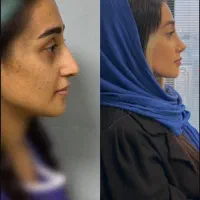 جراحی بینی ، رینوپلاستی ، کوچک کردن بینی
