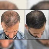 راز پرپشتی مو قرن 2026 فقط همینه