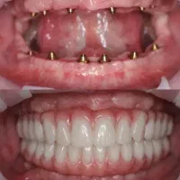 خدماتvipدندانپزشکی(ایمپلنت،اوردنچر،زیبایی)اقساطی