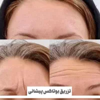 کاشت مو ابرو پرسینگ ژل بوتاکس پی آرپی چالگونه
