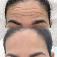 بوتاکس فیلر فیشال لاغری لیزر مزوprp لیزرتتو