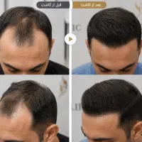 کاشت مو