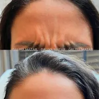 تزریق ژل (فیلر) وبوتاکس و لیفت بانخ ومادلینگ|خدمات آرایشگری و زیبایی|تهران, هفت حوض|دیوار