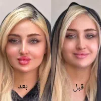 تزریق ژل بوتاکس لیفت صورت وشقیقه آنزیم مزو