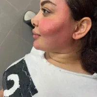 ژل بوتاکس مزو سر ابرو مرو صورت فیلر زیر چشم