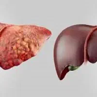 کبد چربتو پاکسازی کن