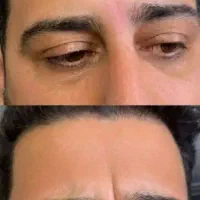 جشنواره بهاره بوتاکس فیلر