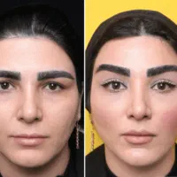 مدل برای جوانسازی و زیباسازی صورت لیفت و رفع لک